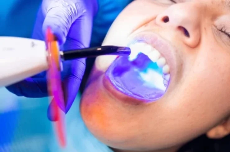 Dental Fillings