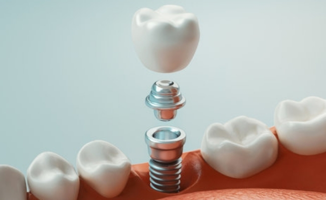 Dental implants-